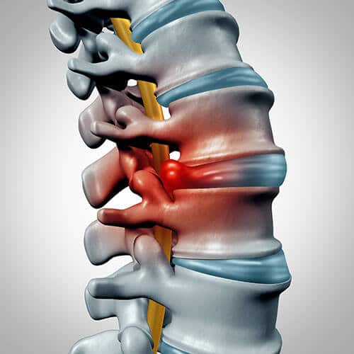 An aching spine