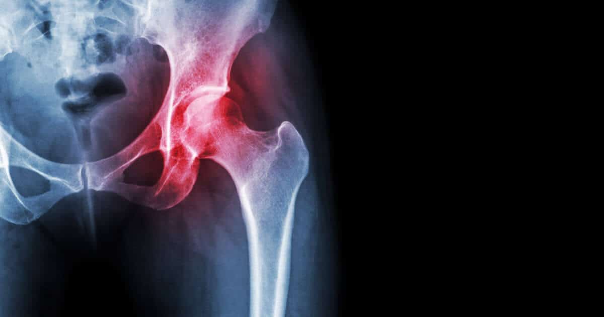 Image of a hip x-ray