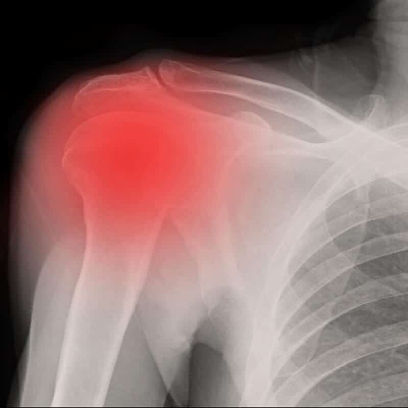 shoulder pain by frozen shoulder