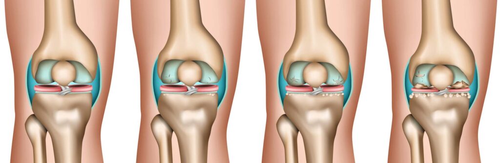 Gonarthrosis progression in 4 stages