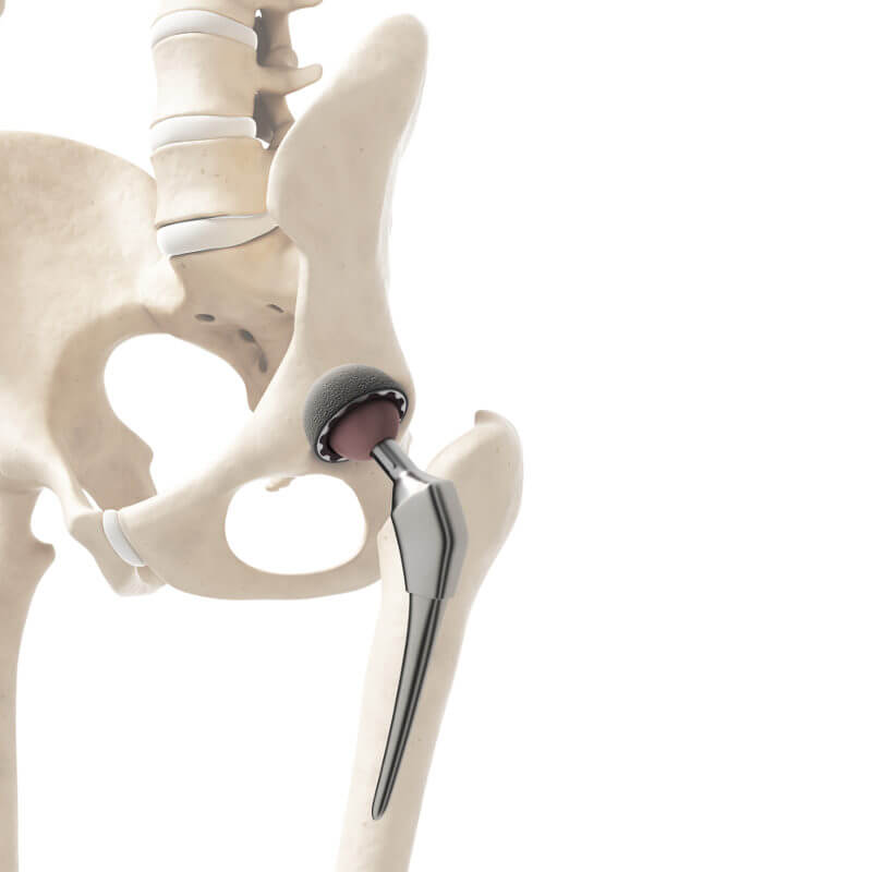 Artificial hip joint on a skeleton