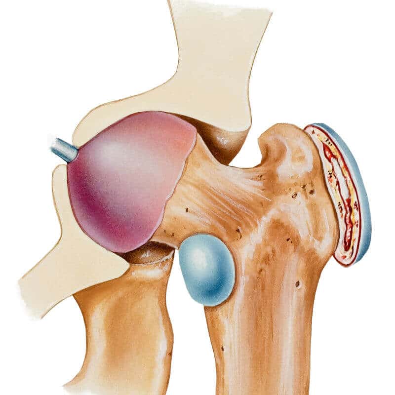Anatomy of the hip with bursitis