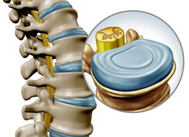 Intervertebral disc in the spine