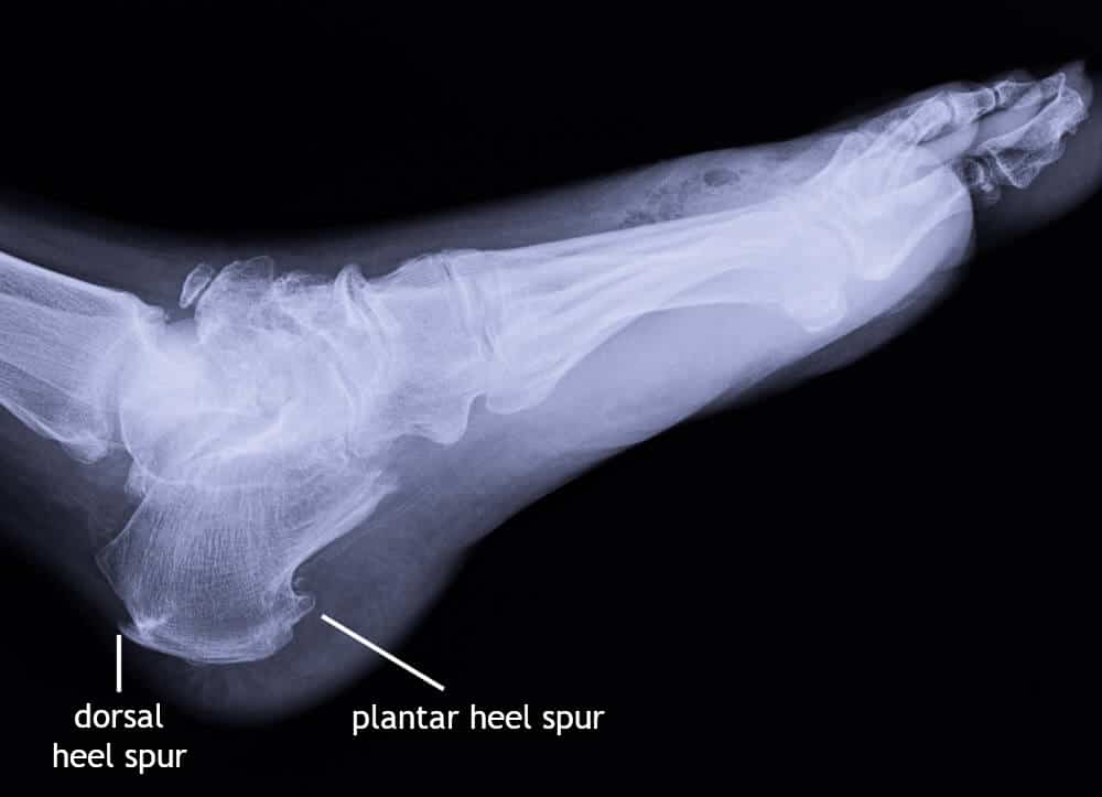X-ray of a foot affected by both plantar and dorsal heel spurs.