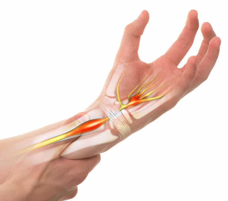 Illustration of carpal tunnel syndrome.