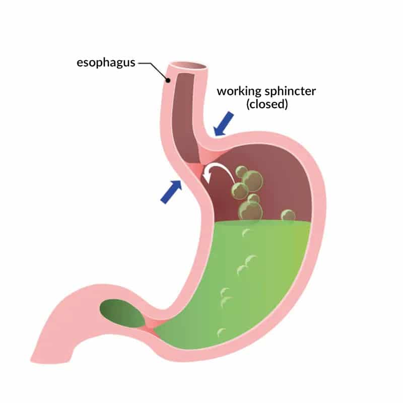 Illustration of the sphincter functioning properly.