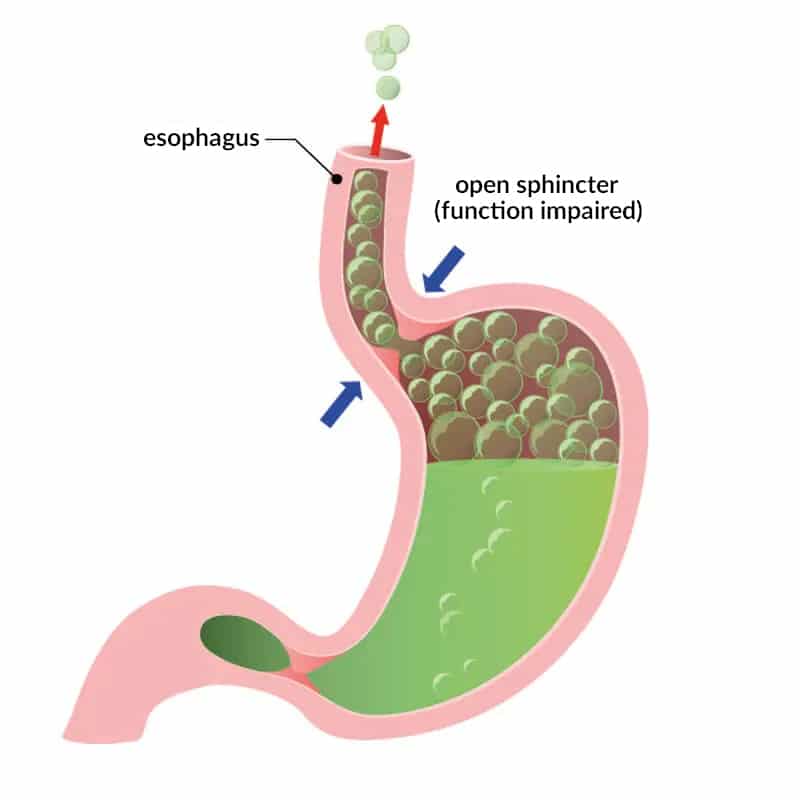 Illustration of an impaired sphincter.