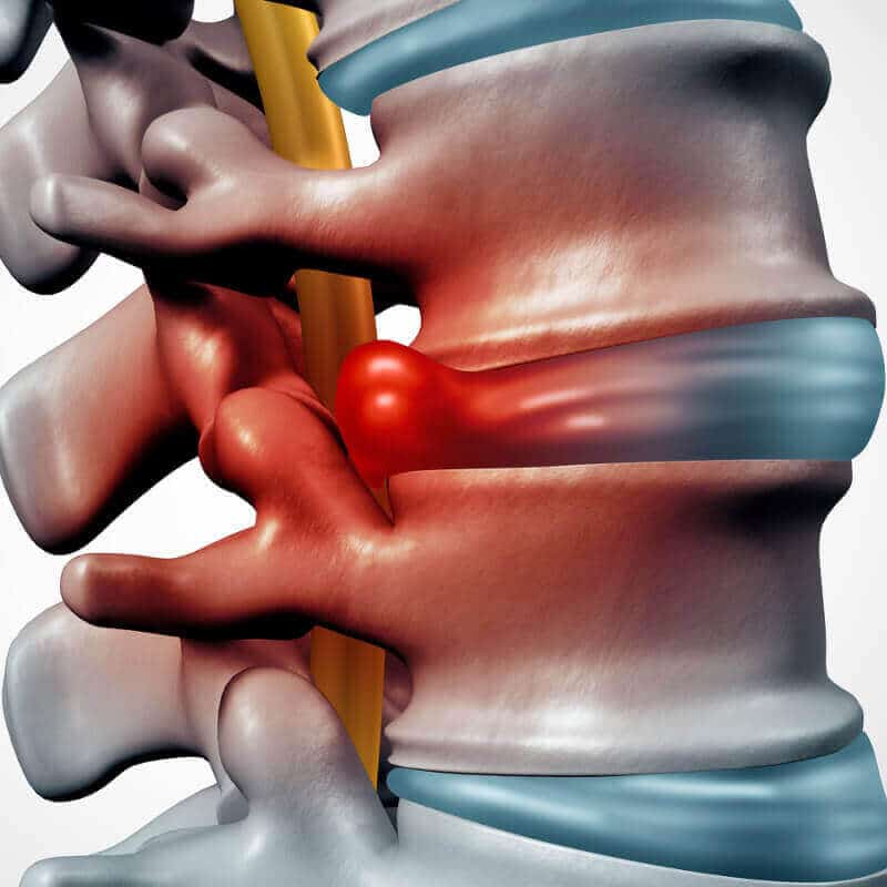 Illustration of a herniated disc.