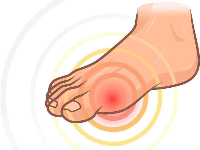 An illustration of the pain occuring with a hallux rigidus.