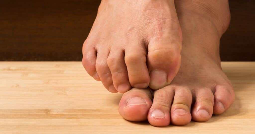 A photograph of a pair of feet affected by hallux rigidus.