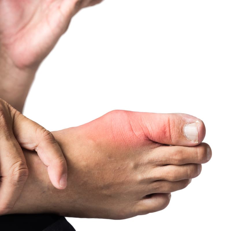 An image of hallux rigidus.