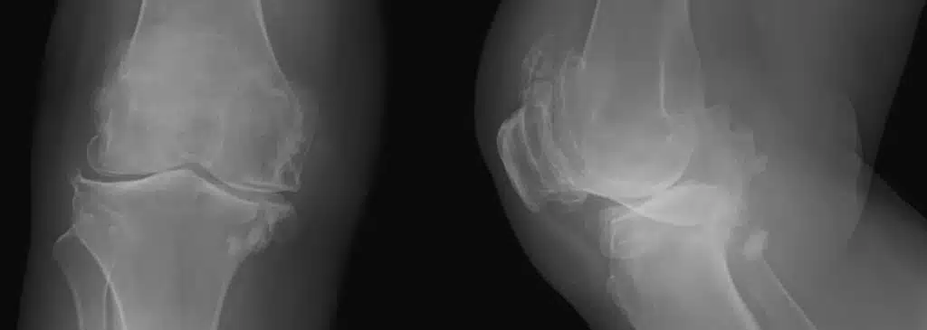 MRI of knees